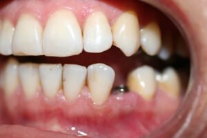 ZA52 before implant