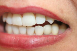 ZA53 after implant